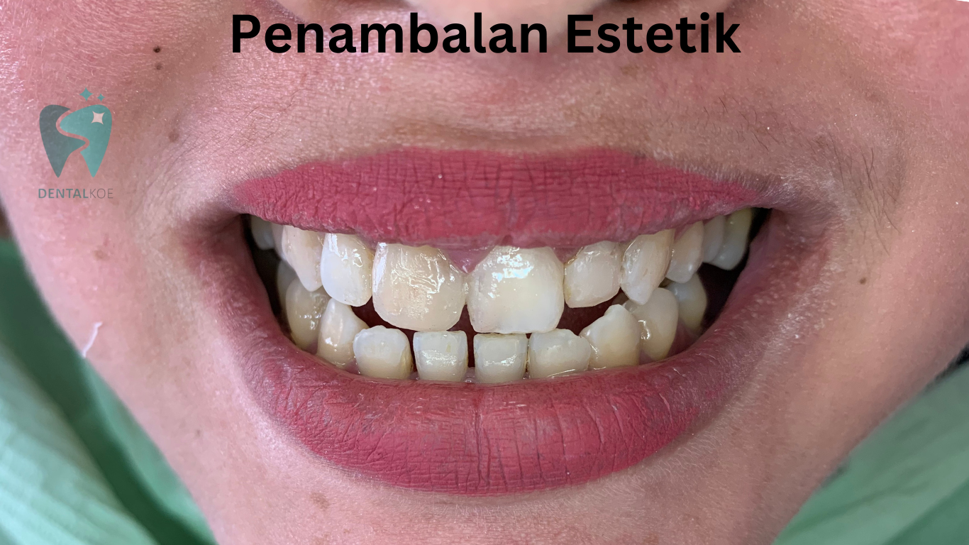 Penambalan Estetik (3)