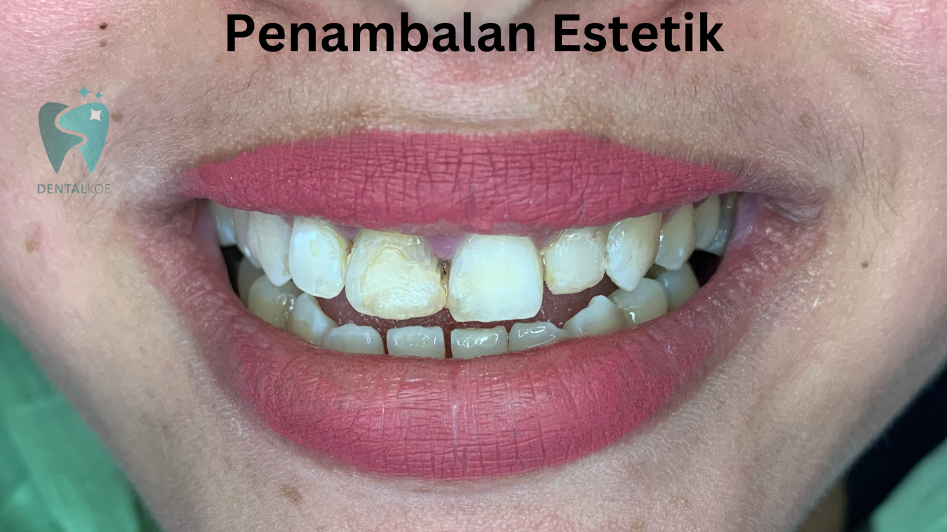 Penambalan Estetik